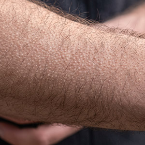 Why Do We Get Goosebumps?